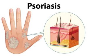 Lee más sobre el artículo ¿Es la psoriasis un problema común?