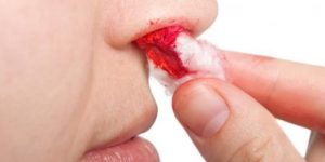 Lee más sobre el artículo Me sangra la nariz ¿Es grave?