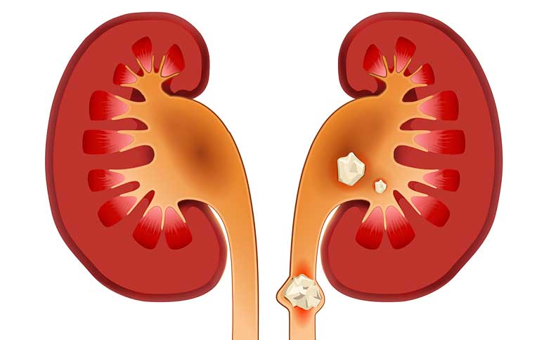 Lee más sobre el artículo Cálculos en el riñón – ¿Por qué salen y cómo tratarlos?